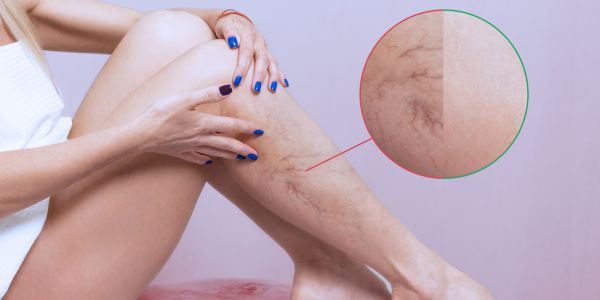 Get Rid of Varicose Veins and Increase Blood Flow