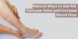 Get Rid of Varicose Veins and Increase Blood Flow