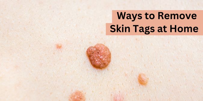 Skin Tags