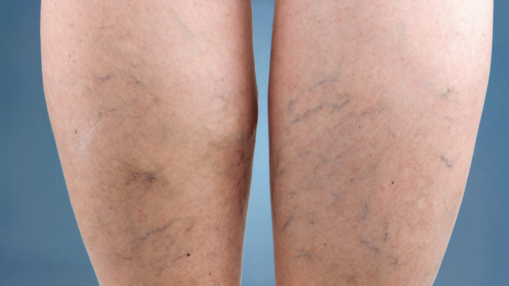 Varicose Veins