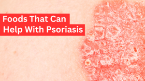 Psoriasis