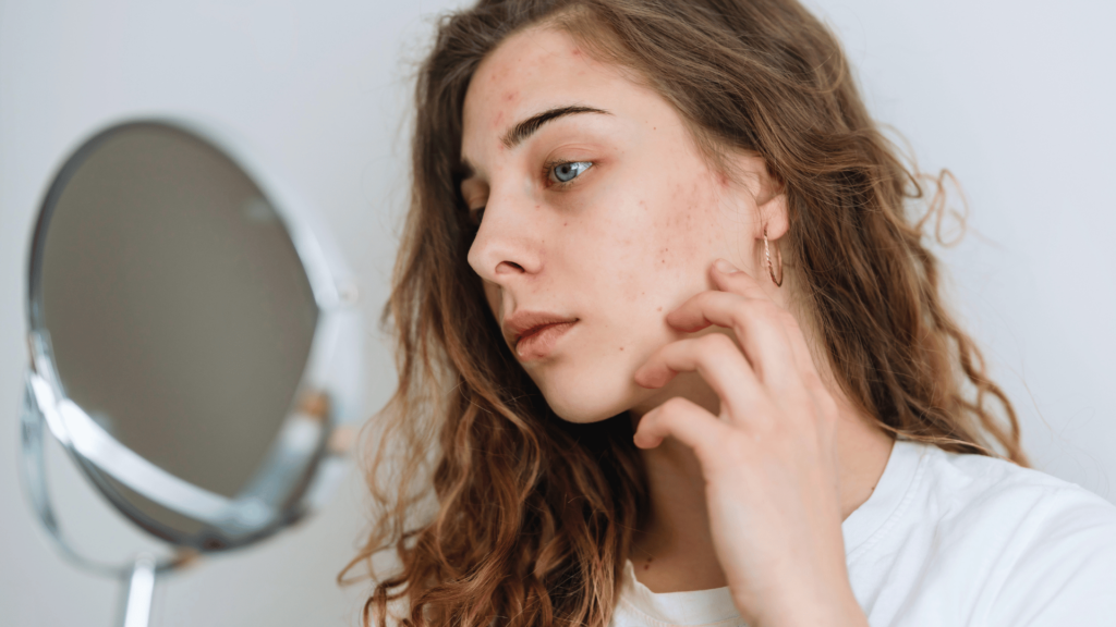 Dry, Flaky Skin and Dandruff