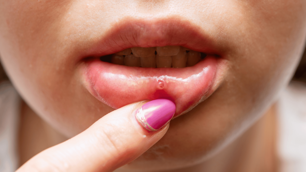 Frequent Mouth Ulcers